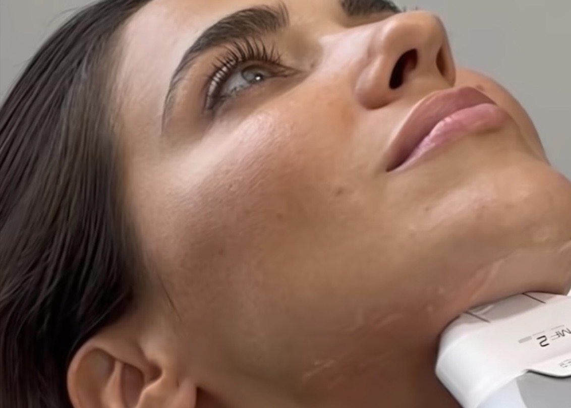 Ultraformer MPT na Longevity  Lifting, firmeza e contorno para rosto e corpo sem downtime